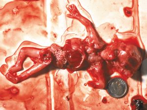 Abortion at 10 weeks