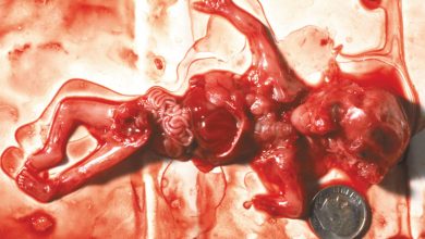 Abortion at 10 weeks