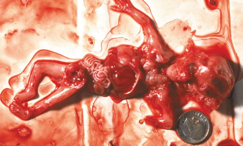 Abortion at 10 weeks
