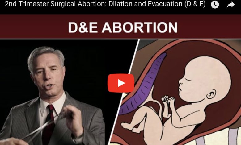 D&E-Abortion