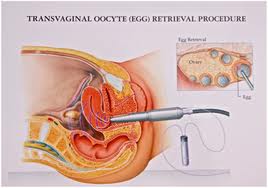 Egg retrieval for in vitro fertilization