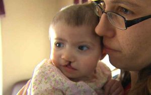 Baby with Cleft Lip