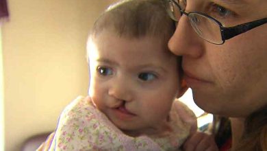 Baby with Cleft Lip