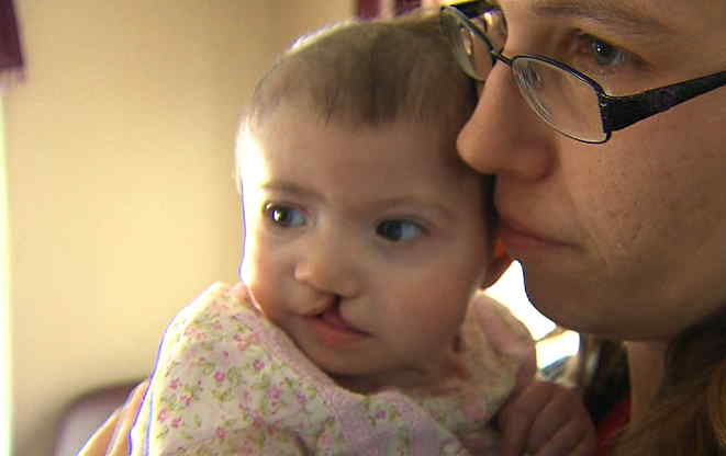 Baby with Cleft Lip