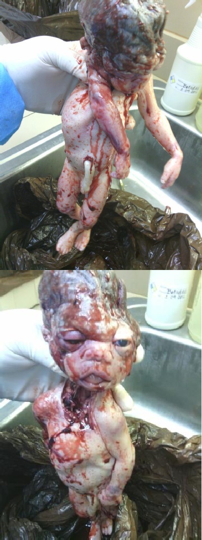 Victim of Torture by Abortion