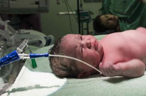 Newborn Baby with Tube