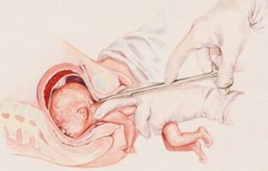 partialbirthabortion