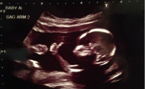 ultrasound