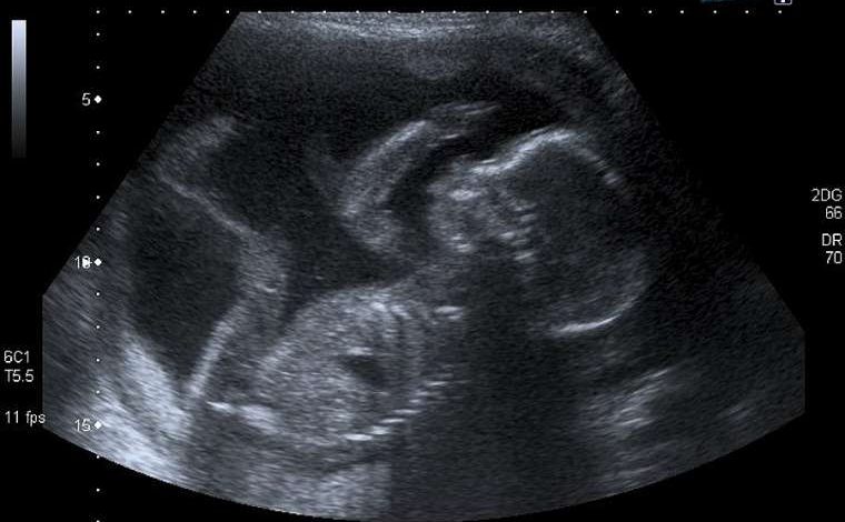 Unborn baby at 20 weeks